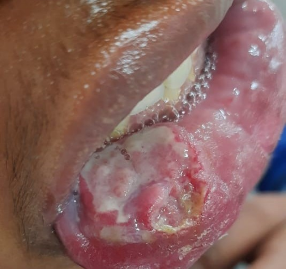 Suspicious oral lesion example