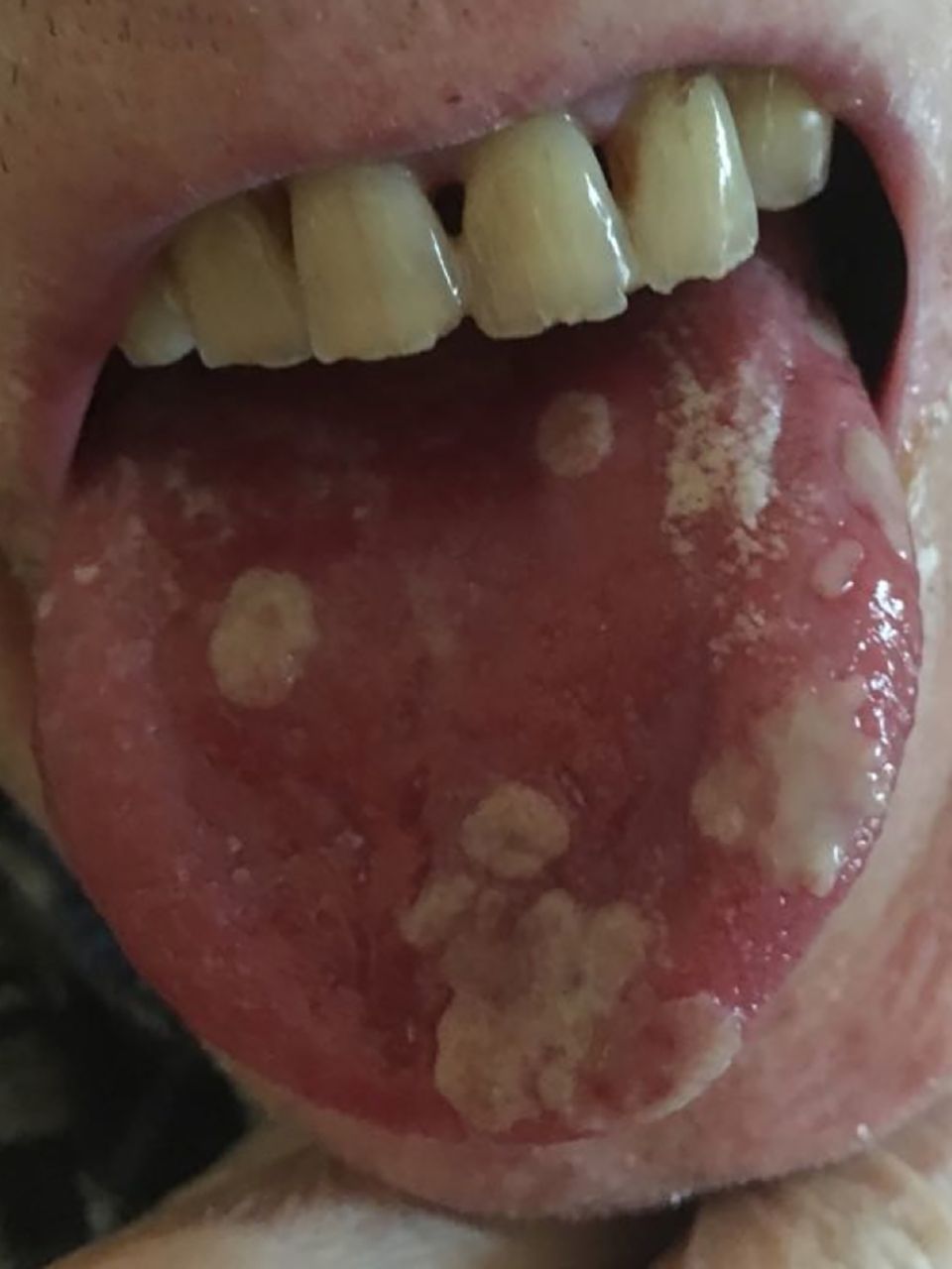Oral candidiasis example